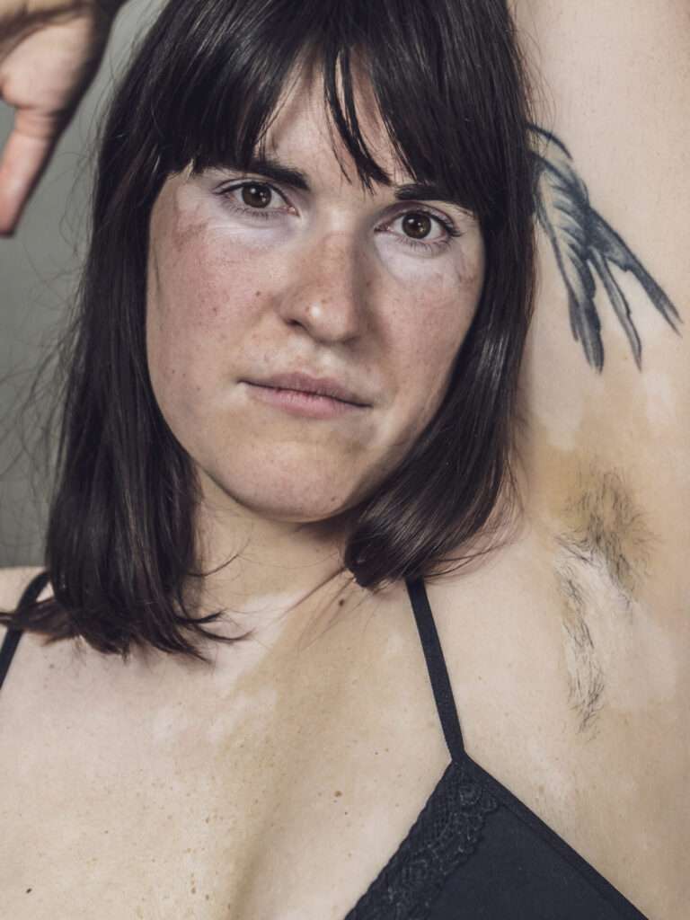 Eine Frau mit Achselhaaren und Vitiligo